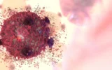 Cientistas Desvendam o Mistério do Fracasso da Imunoterapia Contra o Câncer