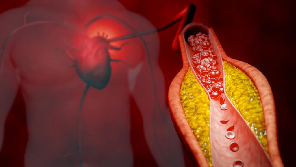 Novo tratamento reduz colesterol em quase 50%, sem estatinas e sem efeitos colaterais