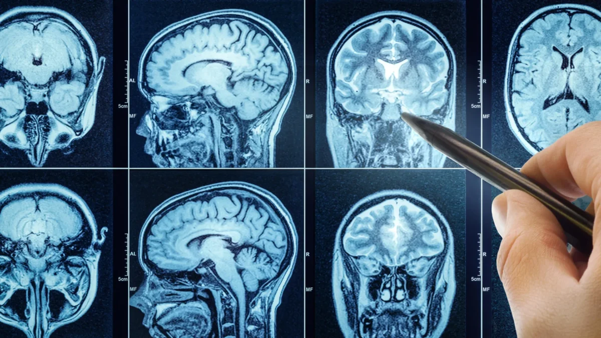O sono inadequado acelera o envelhecimento cerebral e pode aumentar o risco de demência