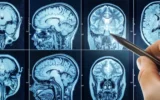 O sono inadequado acelera o envelhecimento cerebral e pode aumentar o risco de demência