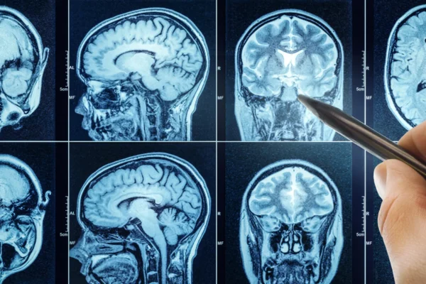 O sono inadequado acelera o envelhecimento cerebral e pode aumentar o risco de demência