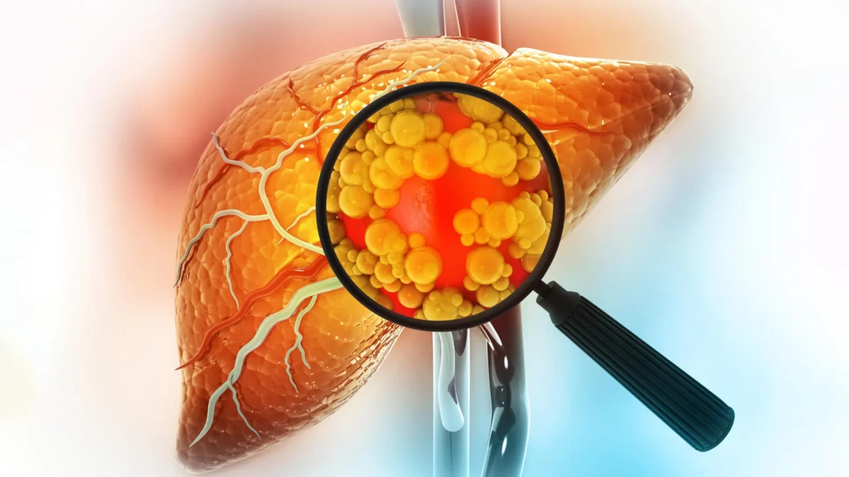 Estudo Surpreendente Revela o Que Realmente Mata Pacientes com Doença Livera Gordurosa