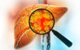 Estudo Surpreendente Revela o Que Realmente Mata Pacientes com Doença Livera Gordurosa