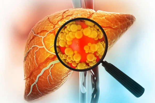 Estudo Surpreendente Revela o Que Realmente Mata Pacientes com Doença Livera Gordurosa