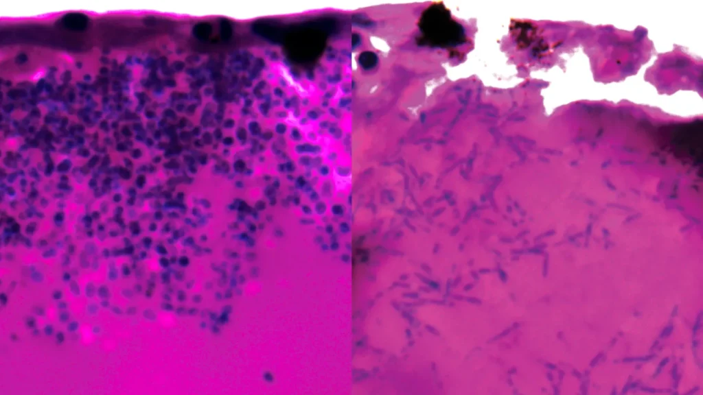Cientistas encontram ponto fraco em fungo mortal que fechou unidades de terapia intensiva de hospitais