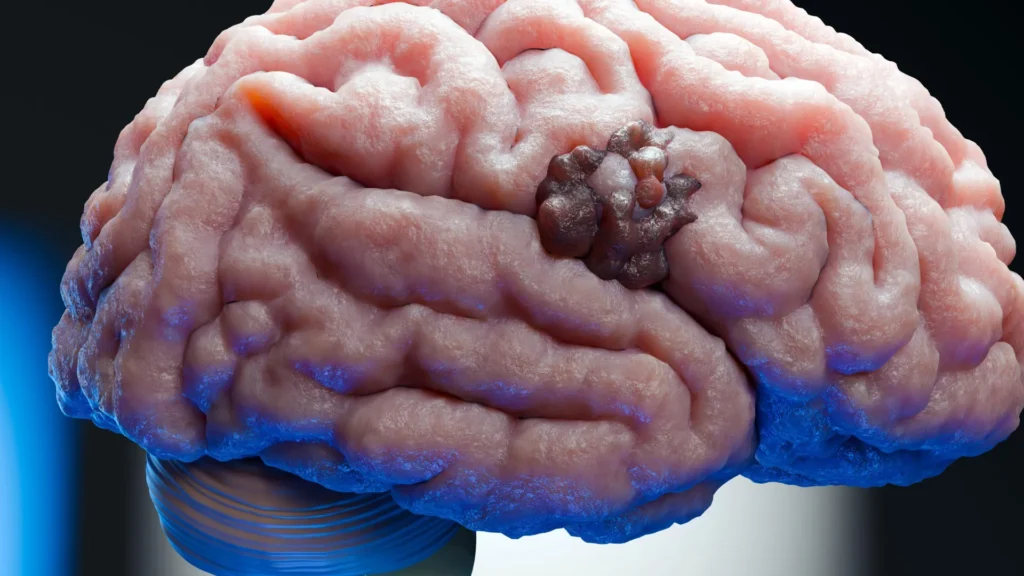 Um remédio para gravidez de 70 anos revela uma fraqueza oculta no câncer de cérebro