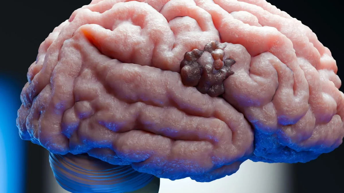 Um remédio para gravidez de 70 anos revela uma fraqueza oculta no câncer de cérebro