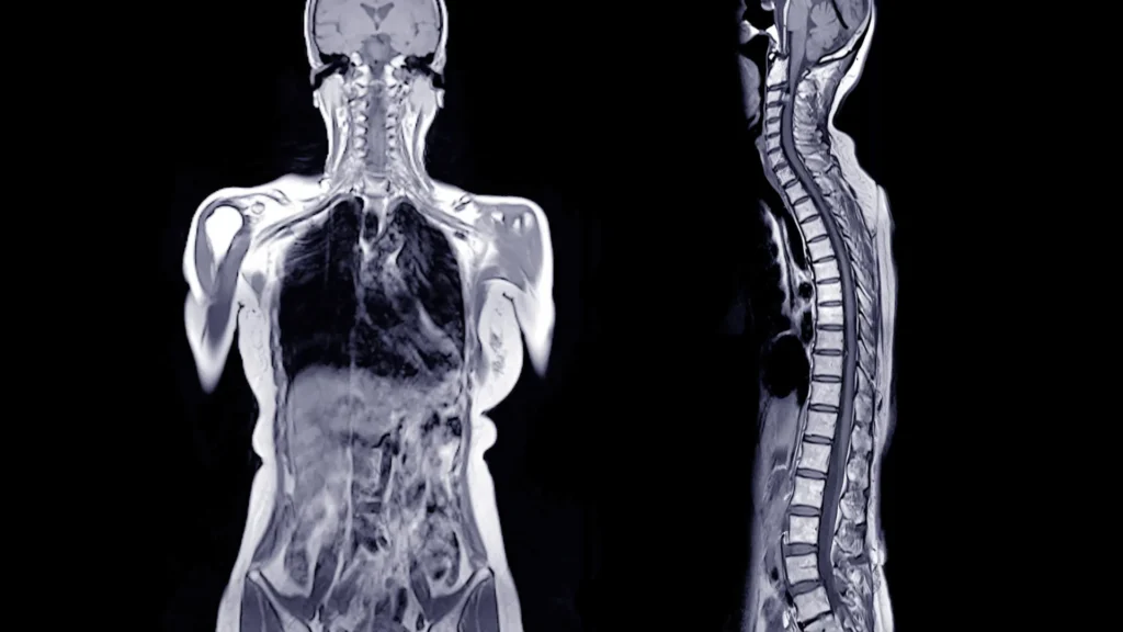 Ele comeu um hambúrguer e morreu horas depois. Médicos descobriram uma causa chocante.