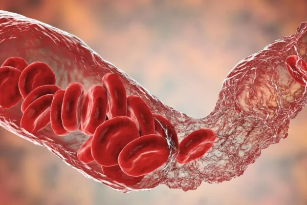 A Long COVID pode ser impulsionada por inflamação e mini coágulos