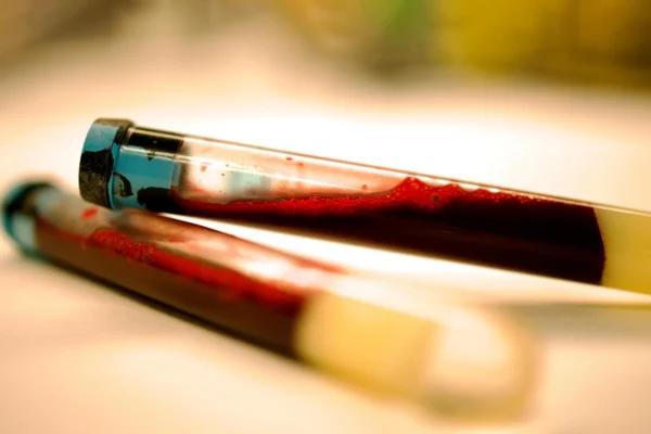 Um simples exame de sangue pode detectar o Parkinson anos antes dos sintomas.