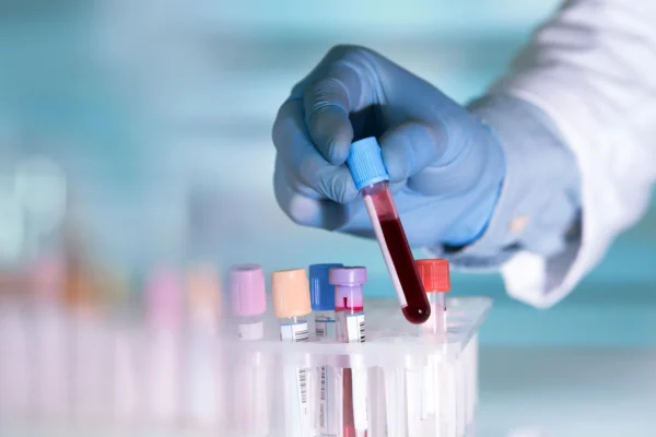 Um exame de sangue pode revelar a doença de Crohn anos antes dos sintomas