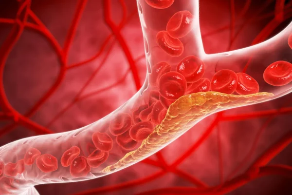 Como o diabetes tipo 2 danifica silenciosamente os vasos sanguíneos