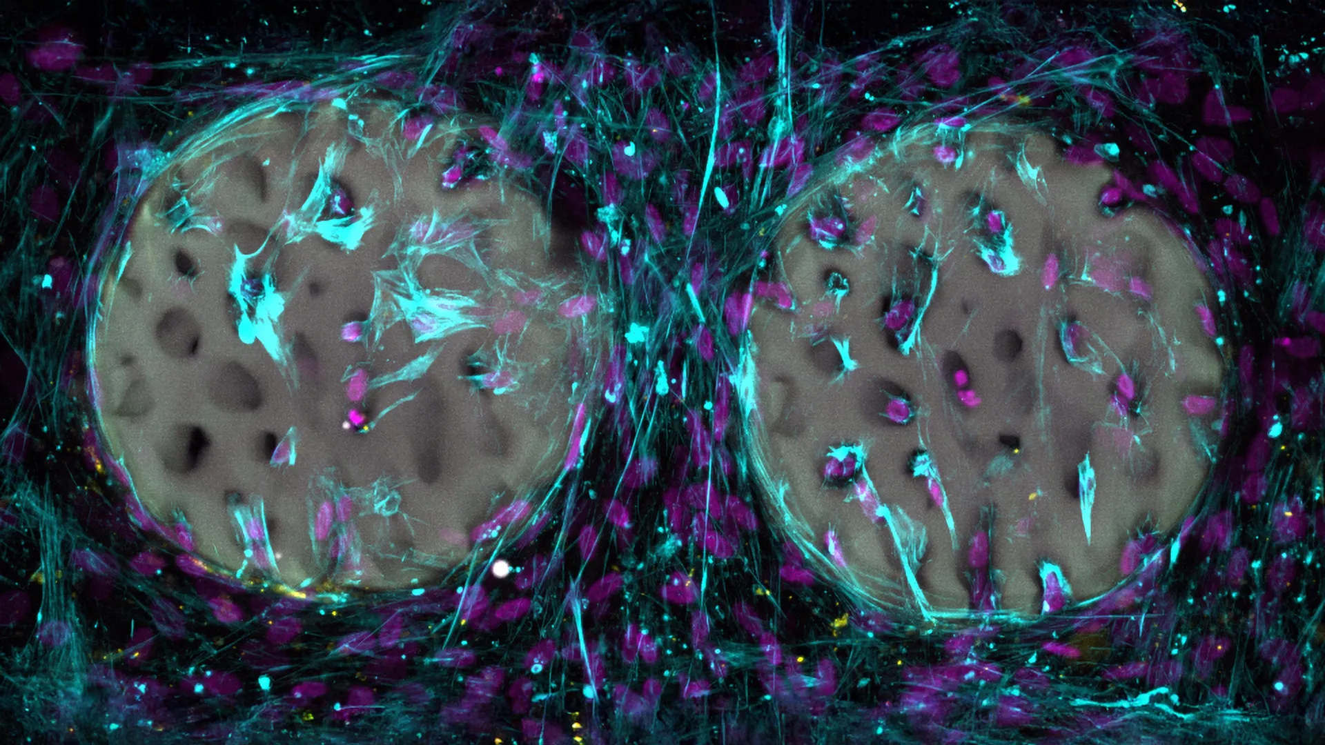 Implante de hidrogel impresso a laser pode transformar a reparação óssea