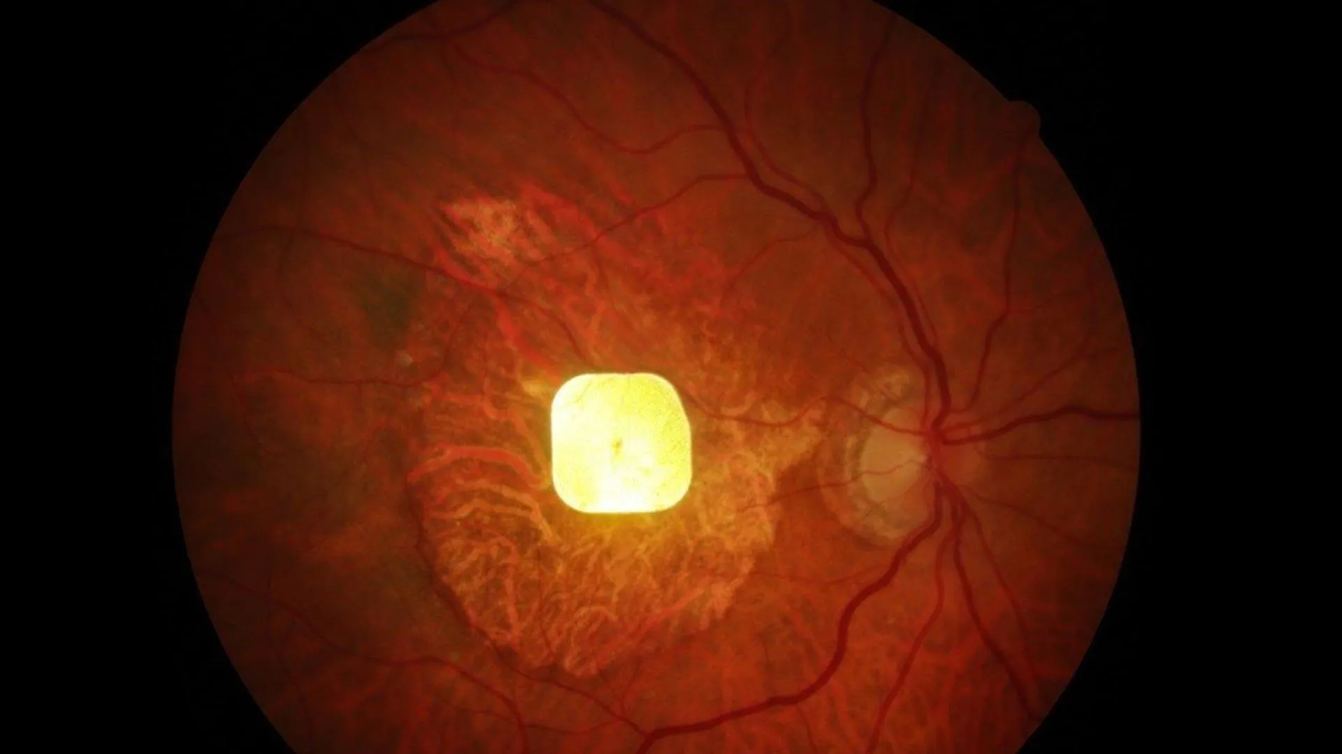 Implante retinal sem fio ajuda pacientes cegos a enxergar novamente