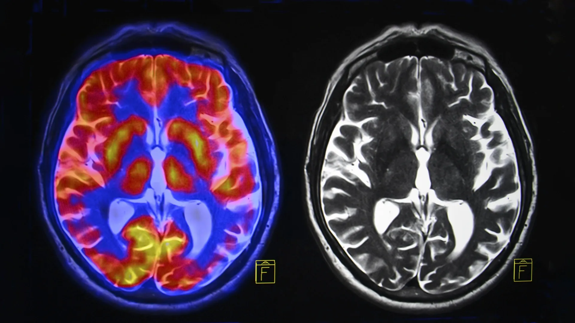 Escaneamentos Cerebrais Revelam Dois Tipos Distintos de Autismo
