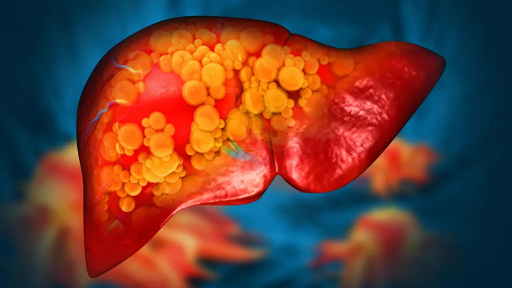 Novo medicamento pode finalmente parar a doença hepática gordurosa mortal